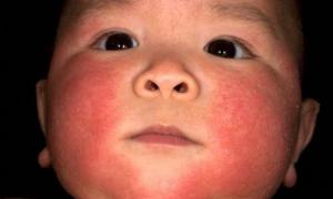 פריחה פולימורפית בעור: כיצד לזהות אריתמה מולטיפורמה